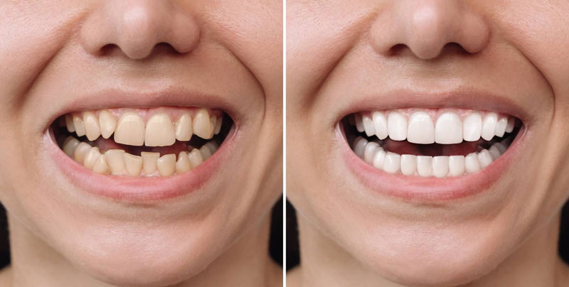 Cosmetic Dentistry in East El Paso - Pearl Dental